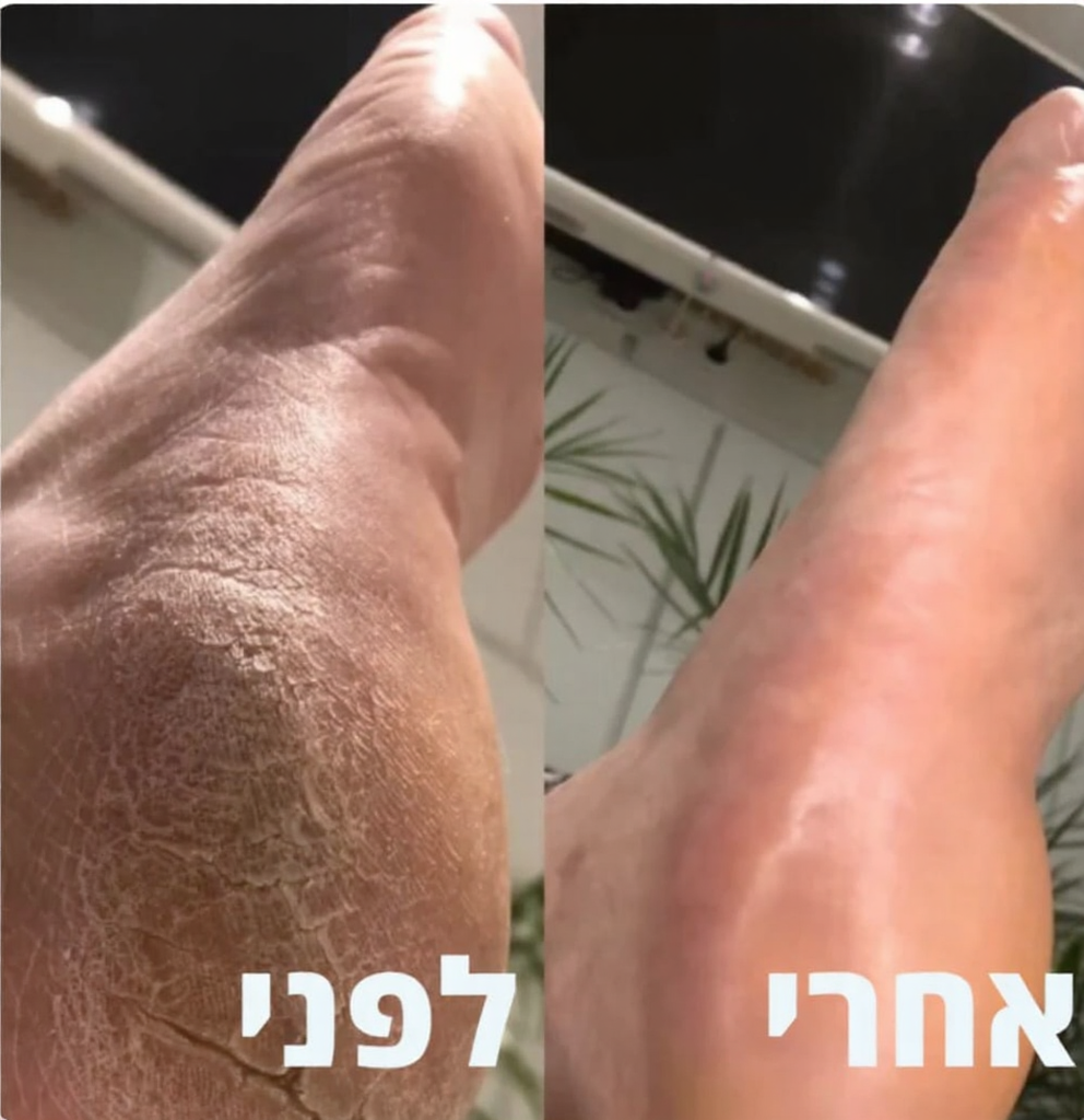 מכשיר להסרת עור יבש פינוק מושלם לעור שלך בכל יום