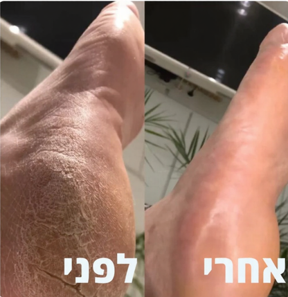 מכשיר להסרת עור יבש פינוק מושלם לעור שלך בכל יום