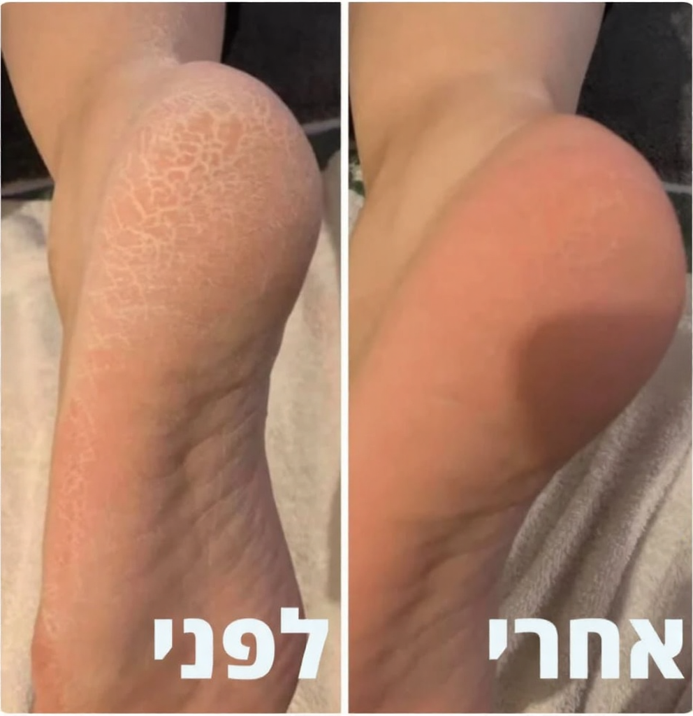 מכשיר להסרת עור יבש פינוק מושלם לעור שלך בכל יום
