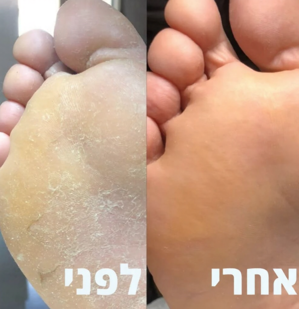 מכשיר להסרת עור יבש פינוק מושלם לעור שלך בכל יום
